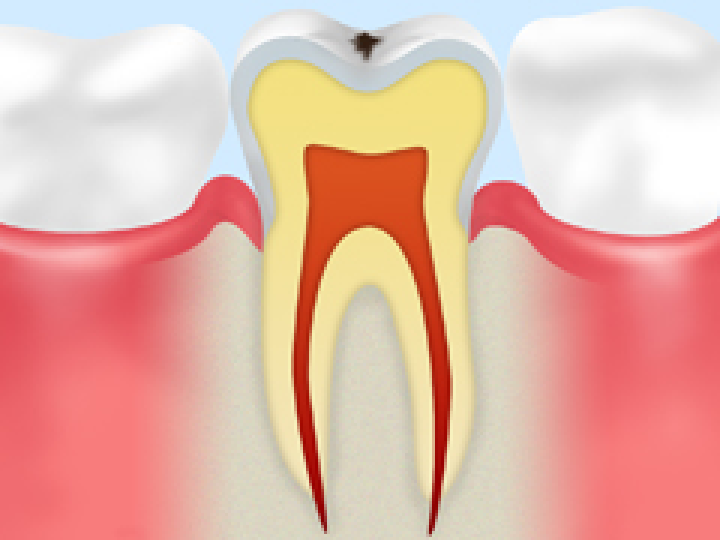 恵比寿の歯医者、かめだ歯科クリニックのむし歯治療