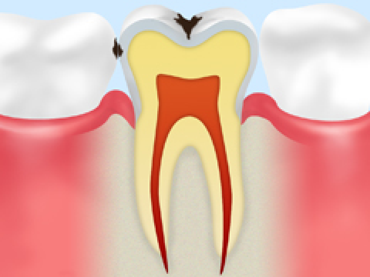 恵比寿の歯医者、かめだ歯科クリニックのむし歯治療