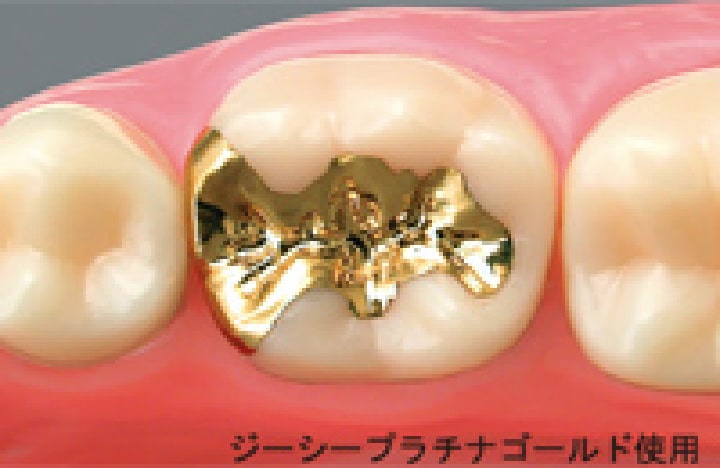 恵比寿の歯医者、かめだ歯科クリニックのゴールドインレー