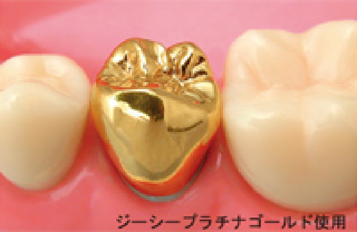 恵比寿の歯医者、かめだ歯科クリニックのゴールドクラウン