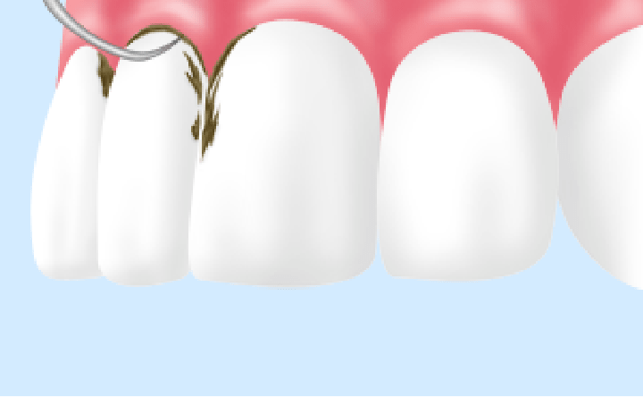 恵比寿の歯医者、かめだ歯科クリニックの歯周病治療